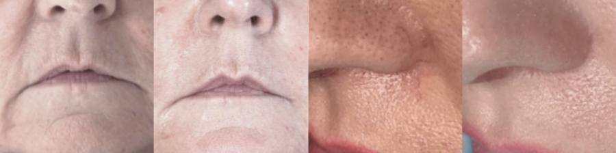 Baby Botox Before After