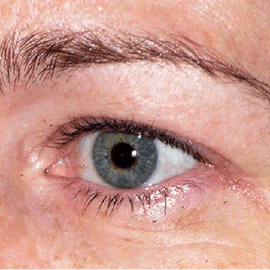 Thermage Eyes - Before