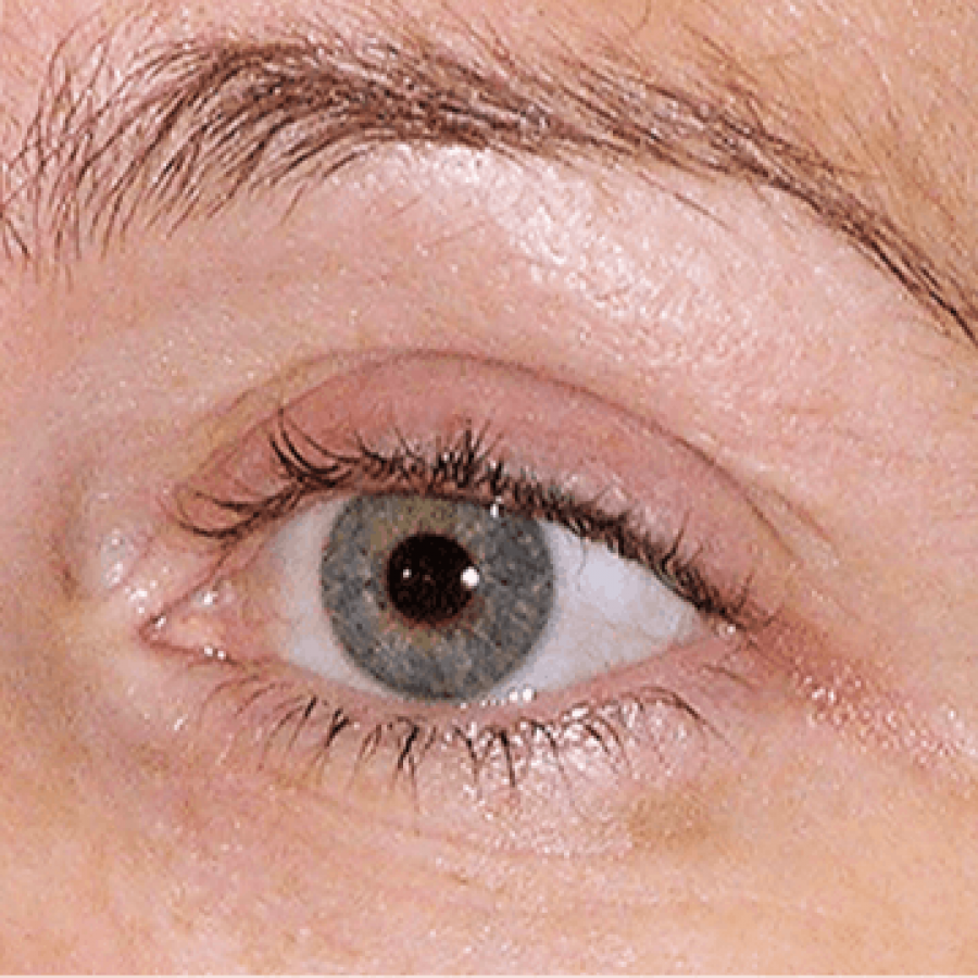 Thermage Eyes - After