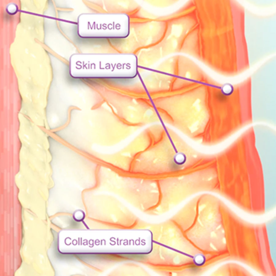 Thermage - How it Works